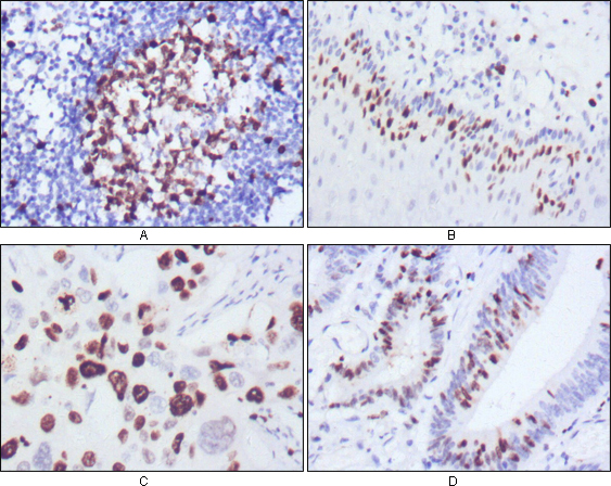 Immunostaining in lung cancer